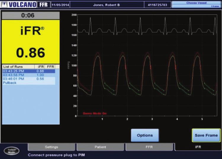 ifr spot measurement Make an ifr spot measurement Make sure that the ECG waveform is displayed with a clear QRS complex Remove wire introducer, flush guide catheter with saline to remove any residual