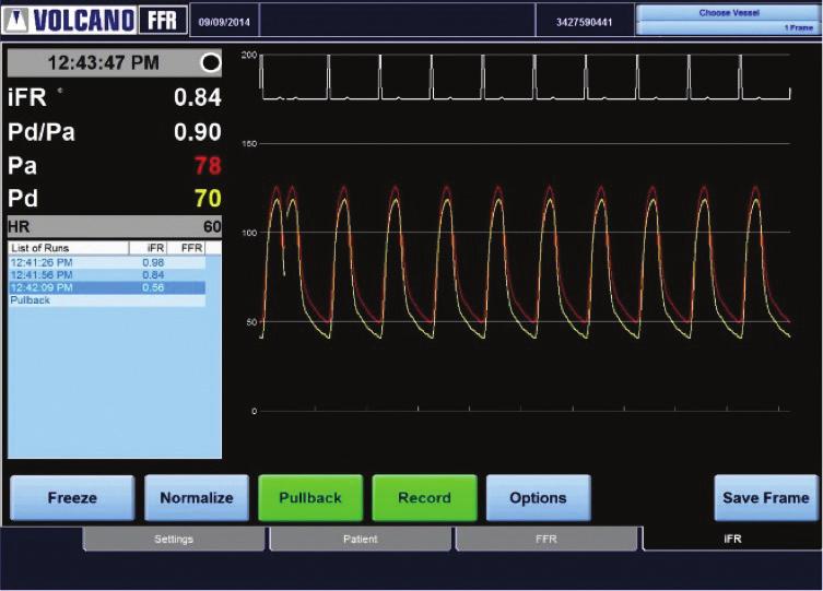 ifr pullback measurement Make an ifr pullback measurement Make sure that the ECG waveform is displayed with a clear QRS complex Position the guide wire pressure sensor distal to all visible stenoses