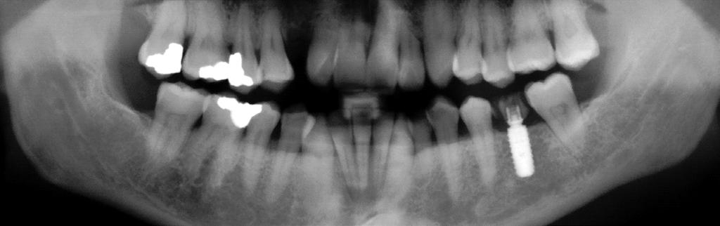 18: panorama x-ray after insertion and restoration of the implant with a temporary crown.