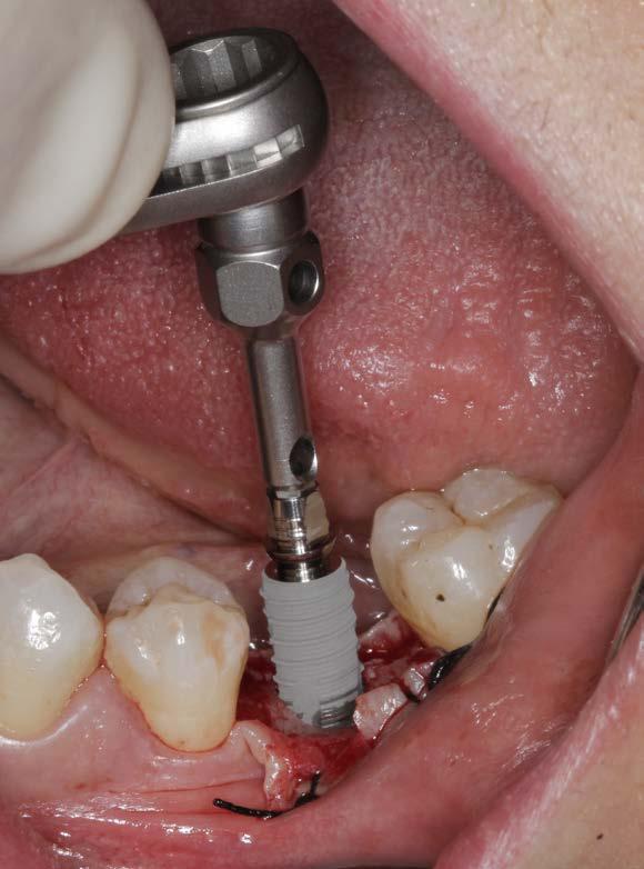 To this purpose, the insertion tool is inserted into the implant base until it audibly snaps into place under
