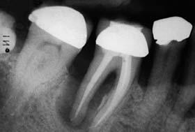 As it hd fvourle ntomy it ws chosen for hemisection, nd endodontic therpy of the tooth ws crried out to high stndrd.