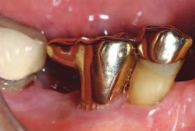218 c Fig 7 Definitive restortive phse: the finl restortion ws fricted from gold (Cookson 620, type 4 lloy) with distl extension mking contct with djcent tooth.