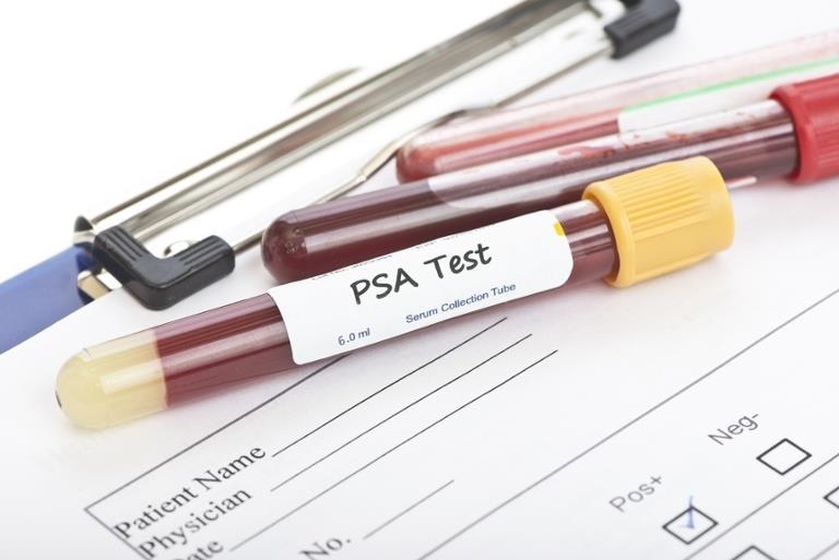 Prostate Specific Antigen What is PSA?