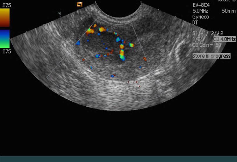 Preoperative diagnosis: Transvaginal sonography No pathognomonic signs What can help: ESS Form Mass derived from