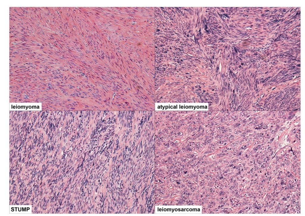 Smooth muscle cell tumor pathology can be