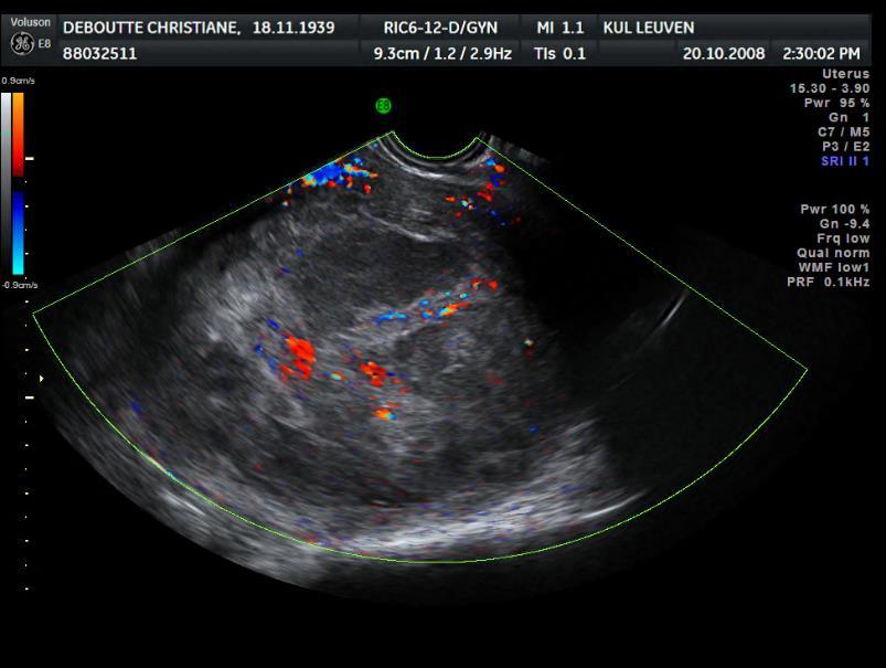 Preoperative diagnosis Transvaginal sonography No pathognomonic signs What may help: Myoma Shape Round Oval LMS Echogenicity Frequent