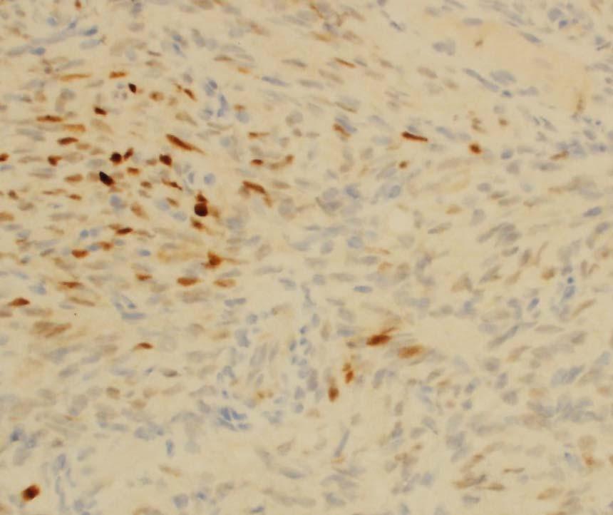 Cyclin D1 in spindle cell