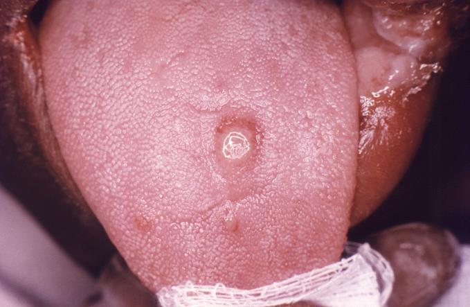 Primary syphilis Incubation period: 3 weeks (3 to 90 days) Chancre: 3mm to 3cm in diameter Initially a painless papule Painless ulcer Clean base Rolled border Associated regional lymphadenopathy