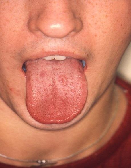 Secondary syphilis Incubation period: Usually 2 to 12 weeks after primary lesion Disseminated disease