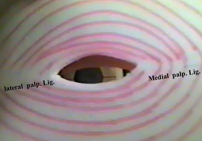 On closure of palpebral fissue, the eye ball is protected by the lids. The lids are covered anteriorly by skin, posteriorly by the palpebral conjunctiva.
