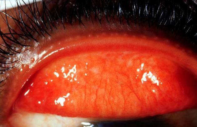 The anterior border: is rounded and carries the cilia (lashes).