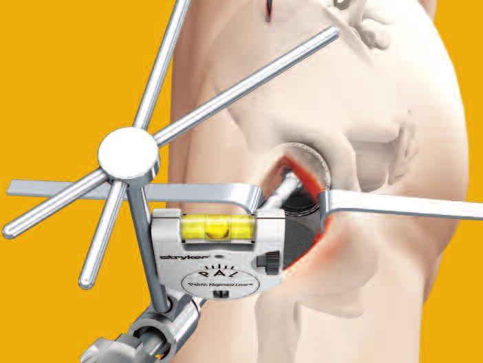 NOTE: It is important to remove the PAL from the pin prior to acetabular reaming or impaction in order to maintain the fixation of the pin in the pelvic bone.