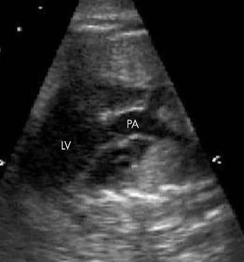 Correctedtranspositioninthefetus 1457 Figure 3 Moving cranially from the four chamber view seen in fig 1, the first vessel visualised is the pulmonary artery (PA).