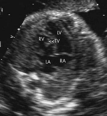 DISCUSSION This diverse category of cardiac abnormality can be diagnosed with a high degree of accuracy in specialised centres, but may be confusing for sonographers and those inexperienced at
