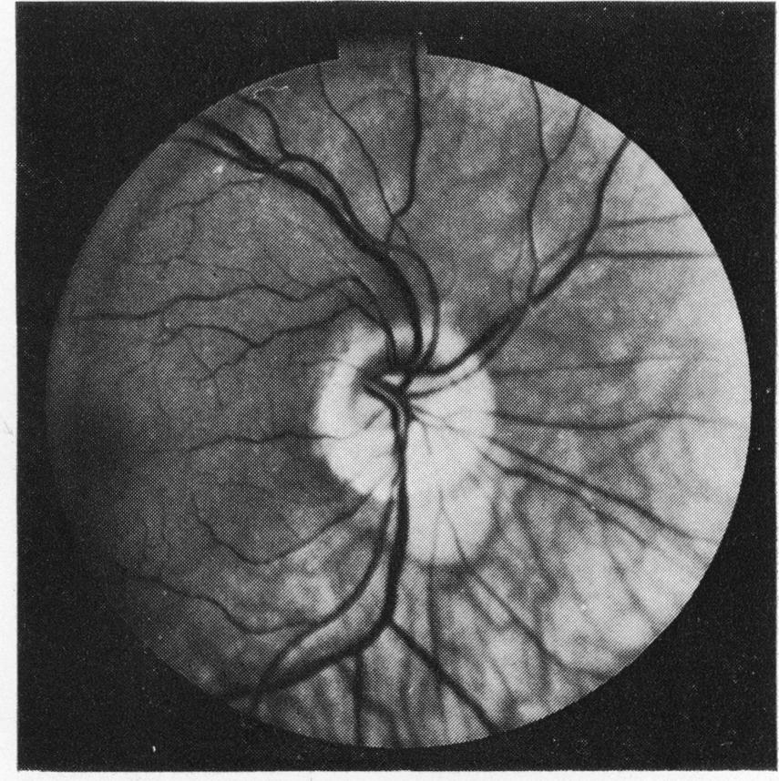 British Journal of Ophthalmology, 1978, 62, 16-20 The tilted disc DAVID DORRELL From the Department of Neuro-Ophthalmology, National Hospitals for Nervous Diseases, Queen Square, London SUMMARY Sixty