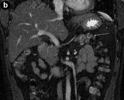 Axial non-contrast computed tomography image shows normal size pancreatic head (thick arrow), splenunculus (thin arrow), stomach and bowel loops in pancreatic bed anterior to splenic vein(arrow head)
