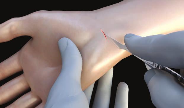 SafeViewTM Antegrade Approach [1] Identify the distal wrist crease, and mark 1-2 cm proximally.