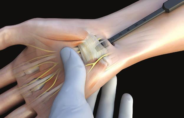 Identify the volar forearm fascia, and incise in line with the skin incision.