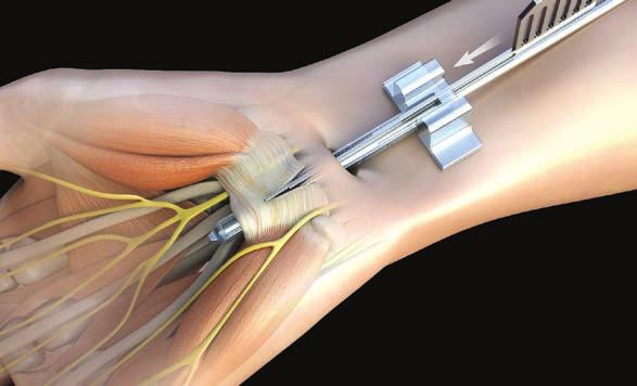 [5] Insert the SafeView cannula, and palpate the palm to position the cannula just distal