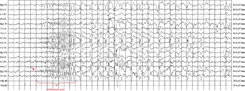 Cerminara et al. Italian Journal of Pediatrics 2013, 39:76 Page 2 of 5 Figure 1 Ictal awake EEG showing runs of rhythmic spikes and sharp waves, over the right fronto-temporal electrodes.