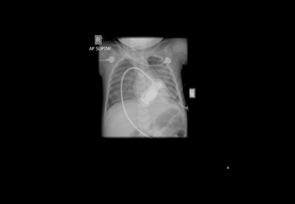 Anatomic Considerations Chest Soft, pliable, soft wall pulmonary contusion Horizontally aligned ribs,
