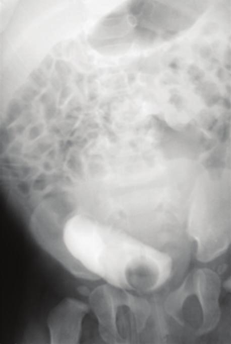 The cyst reached up to the umbilical level (Figure 1(a)).