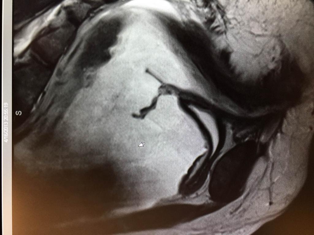 5 pg/ml MRI Pelvis: Uterus present within the pelvis, unremarkable in appearance.