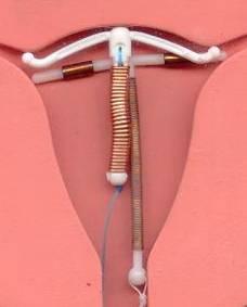Intra-uterine devices Also under development: Swing: copper IUD with a spiral flexible stem IUD