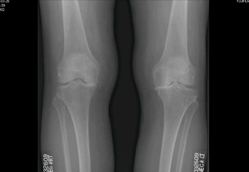 Bilateral Knee
