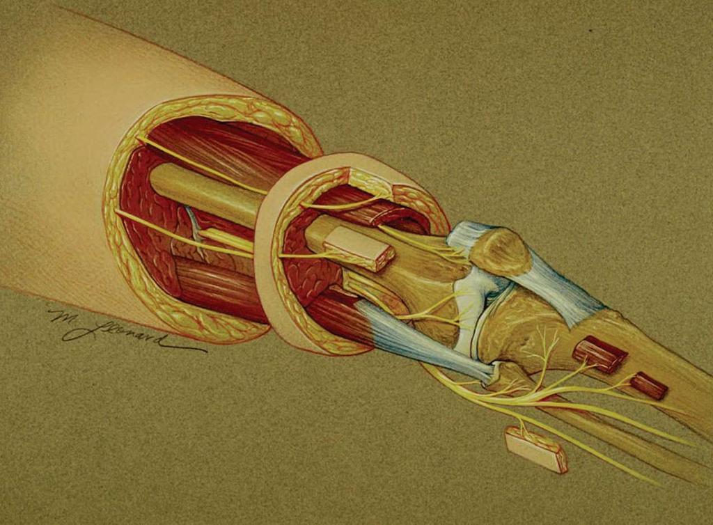 Knee Joint Innervation- Lateral femoral nerve branch to prepatellar bursa lateral retinacular nerve