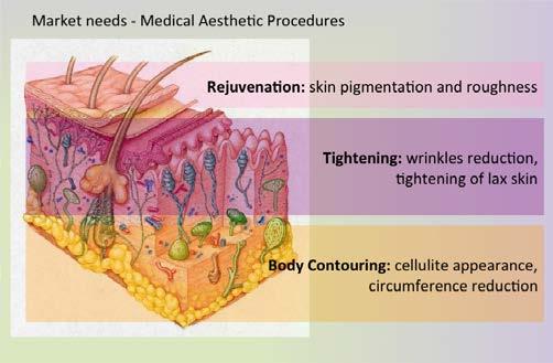 FEB-2015 ISSUE Skin Tightening, Body Contouring, Fractional Skin Resurfacing and Microneedles Skin Remodeling using an innovative 3DEEP, FDA approved, Multisource Phase Controlled RF Device Dr.