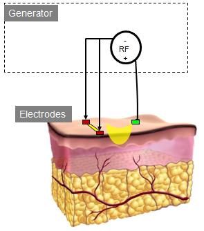 A multipolar device is essentially a bipolar device with multiple positive electrodes and a single negative electrode and a single RF generator.