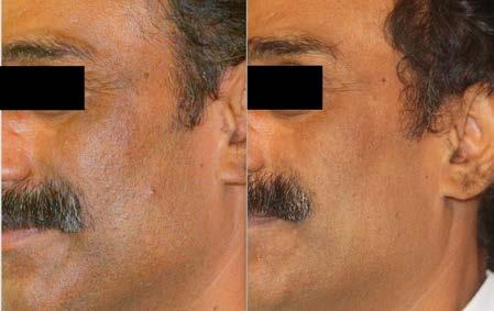 EndyMed s FSR (fractional skin resurfacing) simultaneously performs micro-fractional ablation on the epidermal layer and deep dermal