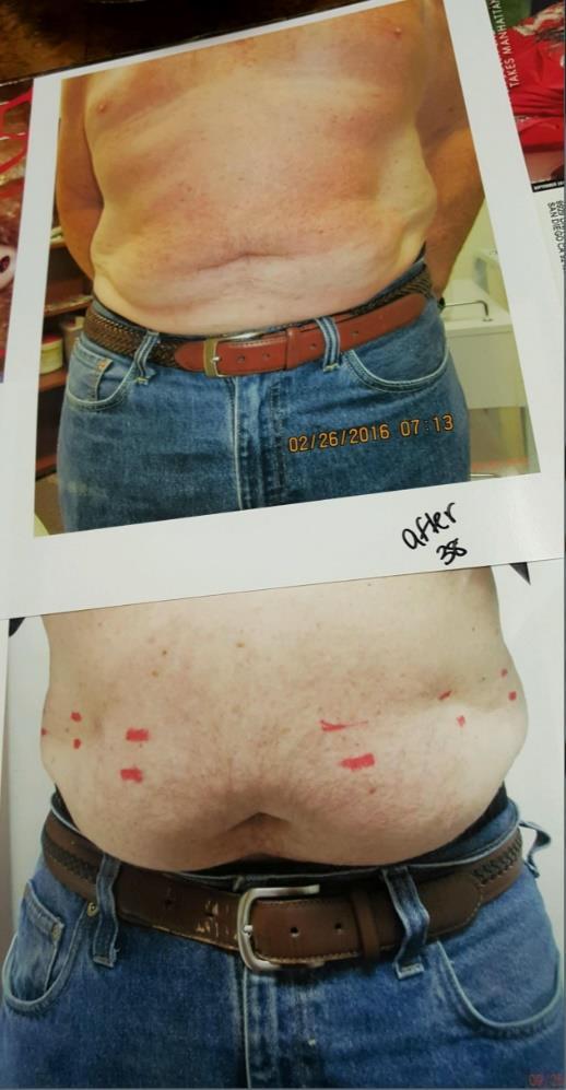 Tristar s Business System A Targeted Fat Loss & Skin Tightening Procedure that is painless, immediate, and effective is finally here and the results can be permanent!