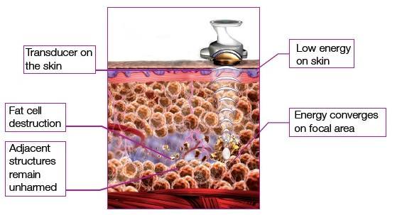 The ultrasound wave causes mechanical disruption of the membranes of the fat cell, sparing the blood vessels, peripheral sensory nerves and connective tissue.