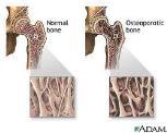 about age 30 Osteoporosis Thinning of bone tissue and a loss of bone density over
