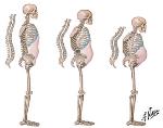 sometimes called a "silent disease" Often, the first indication of osteoporosis