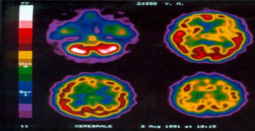 SPECT to evaluate cerebral blood flow alterations in