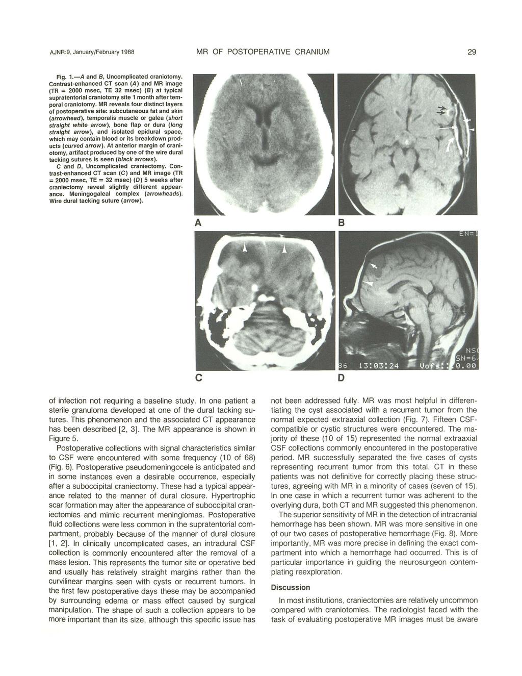 AJNR:9, January/February 1988 MR OF POSTOPERATIVE CRANIUM 29 Fig. 1.-A and B, Uncomplicated craniotomy.