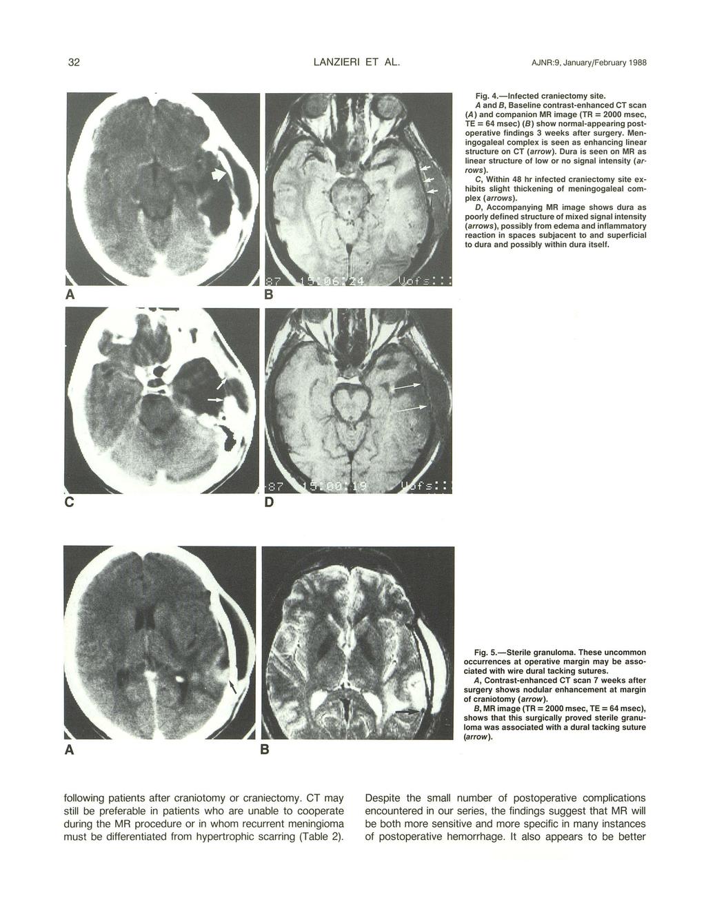 32 LANZI ERI ET AL. AJNR :9, January/February 1988 Fig. 4. - lnfected craniectomy site.