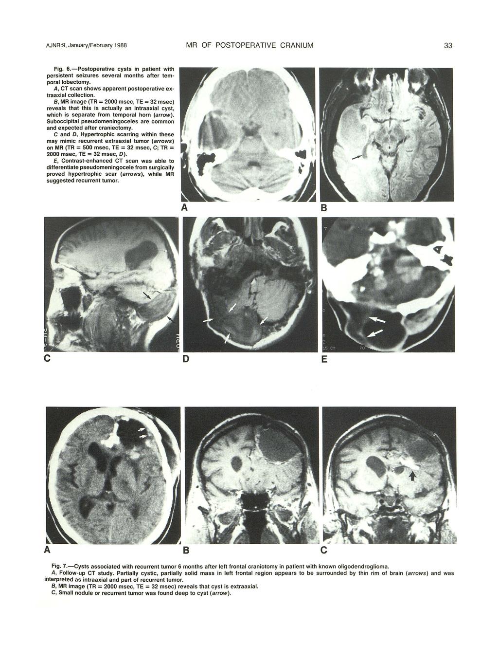 AJNR :9, January/February 1988 MR OF POSTOPERATIVE CRANIUM 33 Fig. 6.-Postoperative cysts in patient with persistent seizures several months after temporallobectomy.