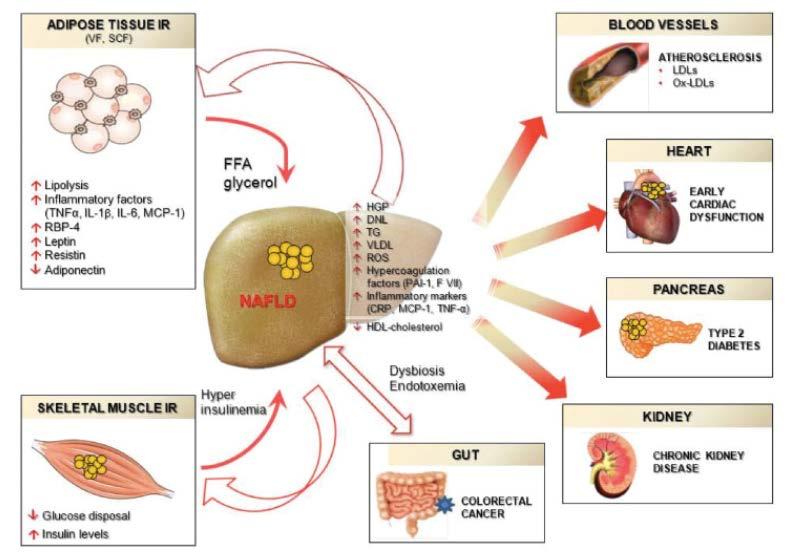Systemic complications of NAFLD