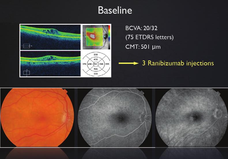 Variable Responses to Intravitreal Anti-VEGF Therapy for DME PAOLO LANZETTA, MD CASE NO.