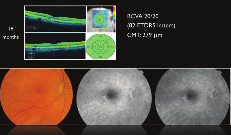 Clinical examination revealed a BCVA of 20/32 (75 ETDRS letters) and a central macular