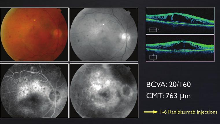 A regimen of 3 monthly intravitral injections of ranibizumab (Lucentis, Novartis) was