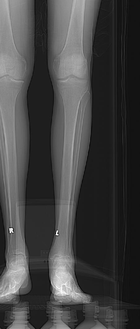 PROPHECY Ankle CT Scan Protocol This ankle protocol involves a section at the knee. REQUIRED: Provide full Knee-to-Foot CT scout images (coronal & sagittal).