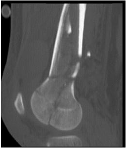 used)? 5. How Often Do We See (Hoffa) Coronal Plane Fractures with Intra-articular Fractures of the Distal Femur?