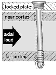3, longer plates D Far Cortical Locking stiffness: >