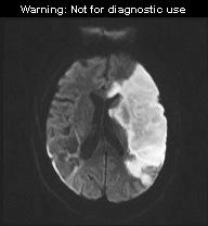 axial DWI MRI