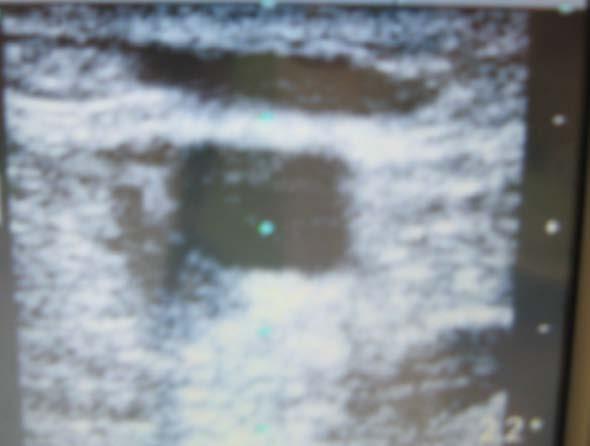 Ultrasound for vessel location Is ultrasound necessary?
